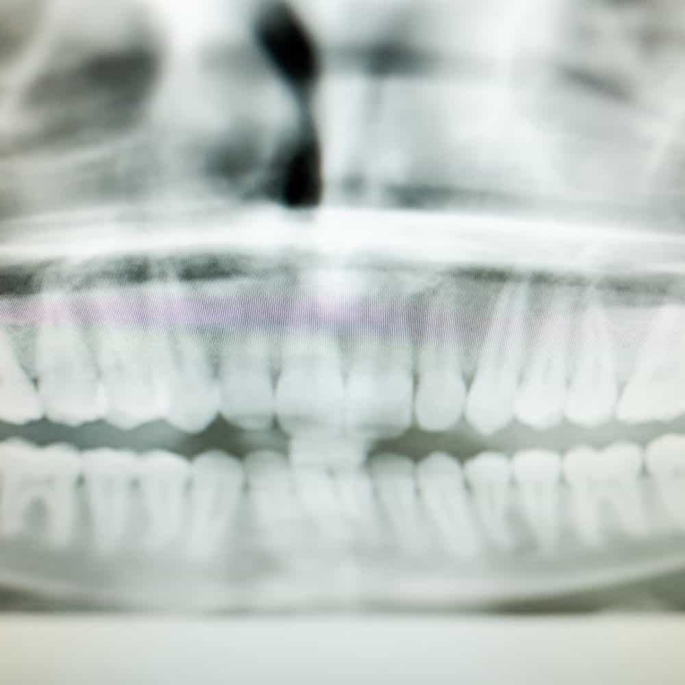 Random Reuland Orthodontics 2018 34 1000x1000 - Braces for Adults