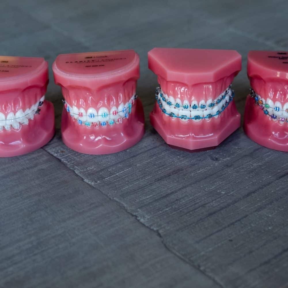 Random Reuland Orthodontics 2018 55 1000x1000 - Types of Braces and Invisible Aligners