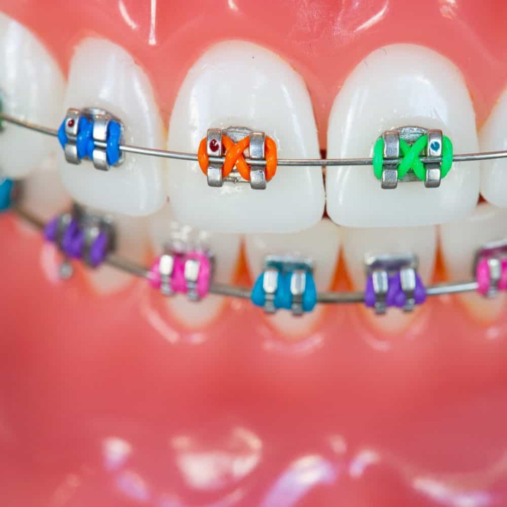 Reuland Orthodontics Treatment Invisalign 3M Clarity Advanced Brackets 2018 5 1000x1000 - Advanced Metal Braces