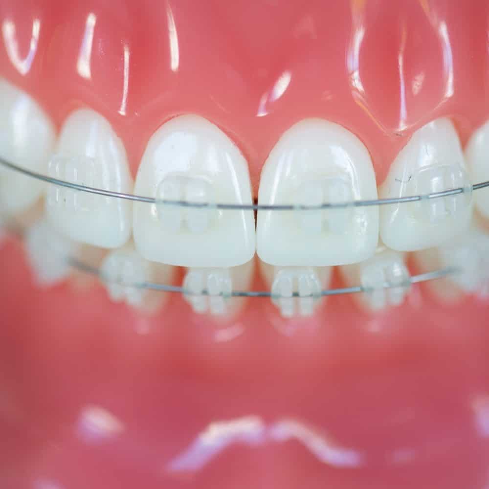 Invisalign Mansfield, TX, Clear Braces