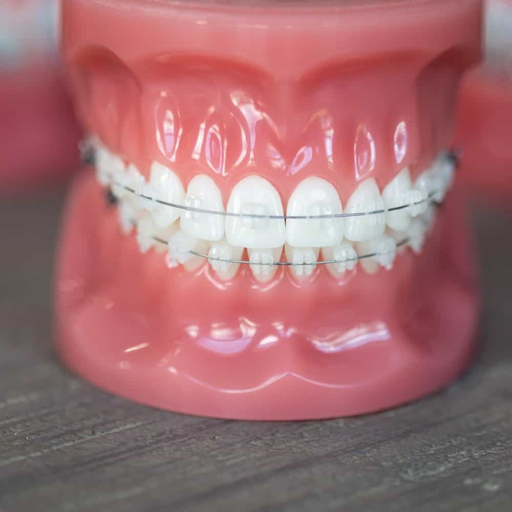 Ceramic Braces Jacksonville, Orthodontist