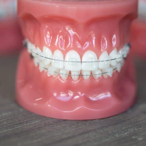 Clear Braces - Reuland & Barnhart Orthodontics in Tyler, TX