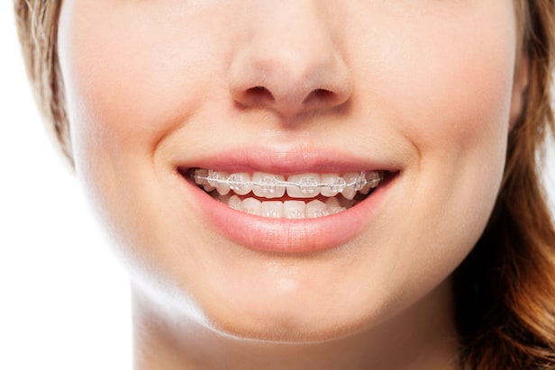 clear braces - Braces Removal