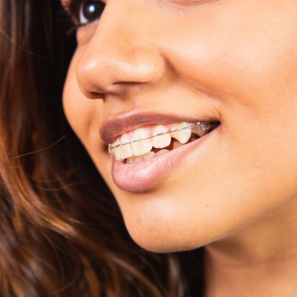 ceramic braces 1000x1000 - Braces for Kids ceramic braces 1000x1000 - Braces for Kids