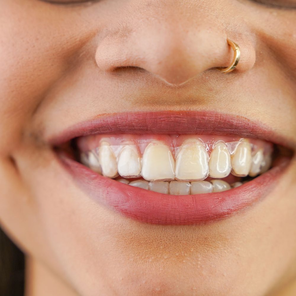 invisalign 1000x1000 - Braces for Kids invisalign 1000x1000 - Braces for Kids