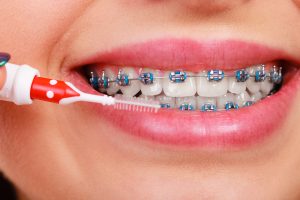 metal braces 300x200 - The Different Types of Braces, Explained