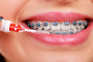 Dentist and orthodontist concept. Young woman cleaning and brushing teeth with blue braces using toothbrush