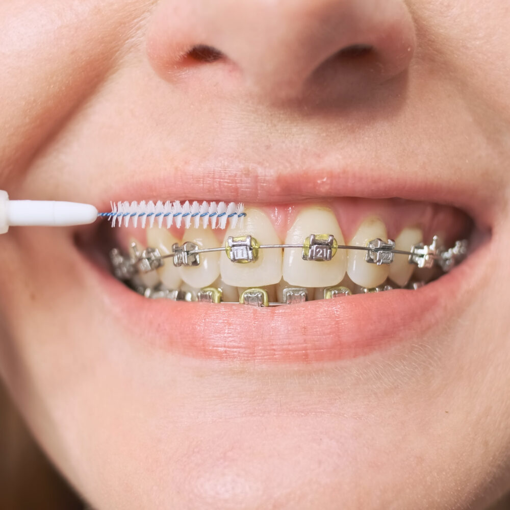 AdobeStock 616919958 1000x1000 - Braces for Kids AdobeStock 616919958 1000x1000 - Braces for Kids