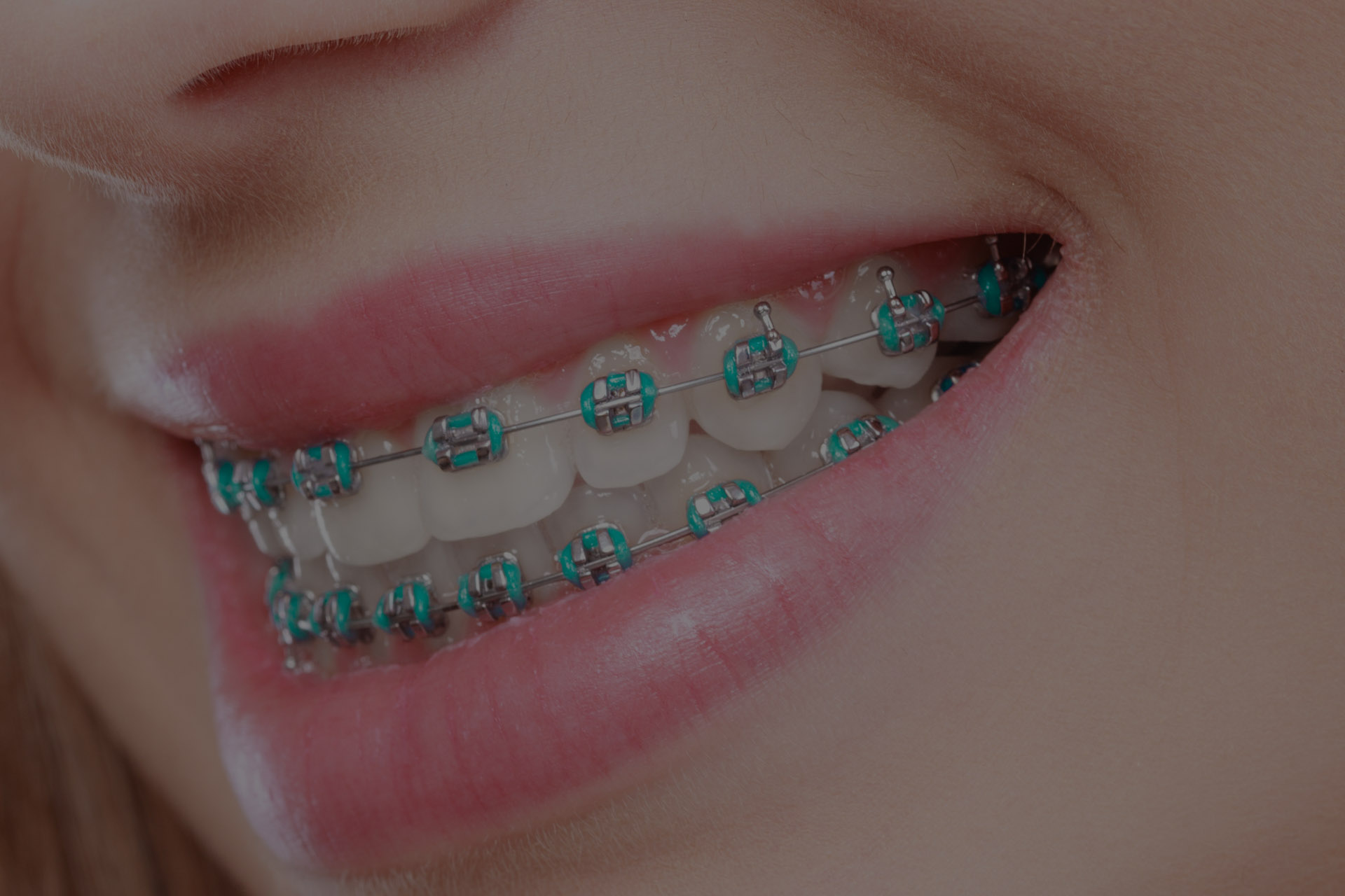 How to Care for Your Braces: Top Tips for Maintenance