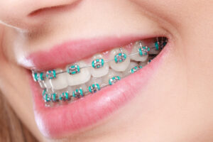 rbortho 177997962 300x200 - Timeline for Orthodontic Treatment: What You Need to Know