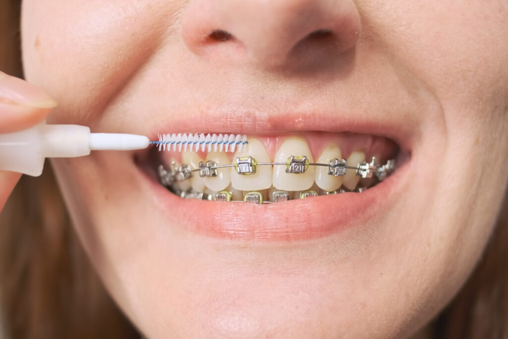 rbortho 616919958 1024x683 - How to Care for Your Braces: Top Tips for Maintenance