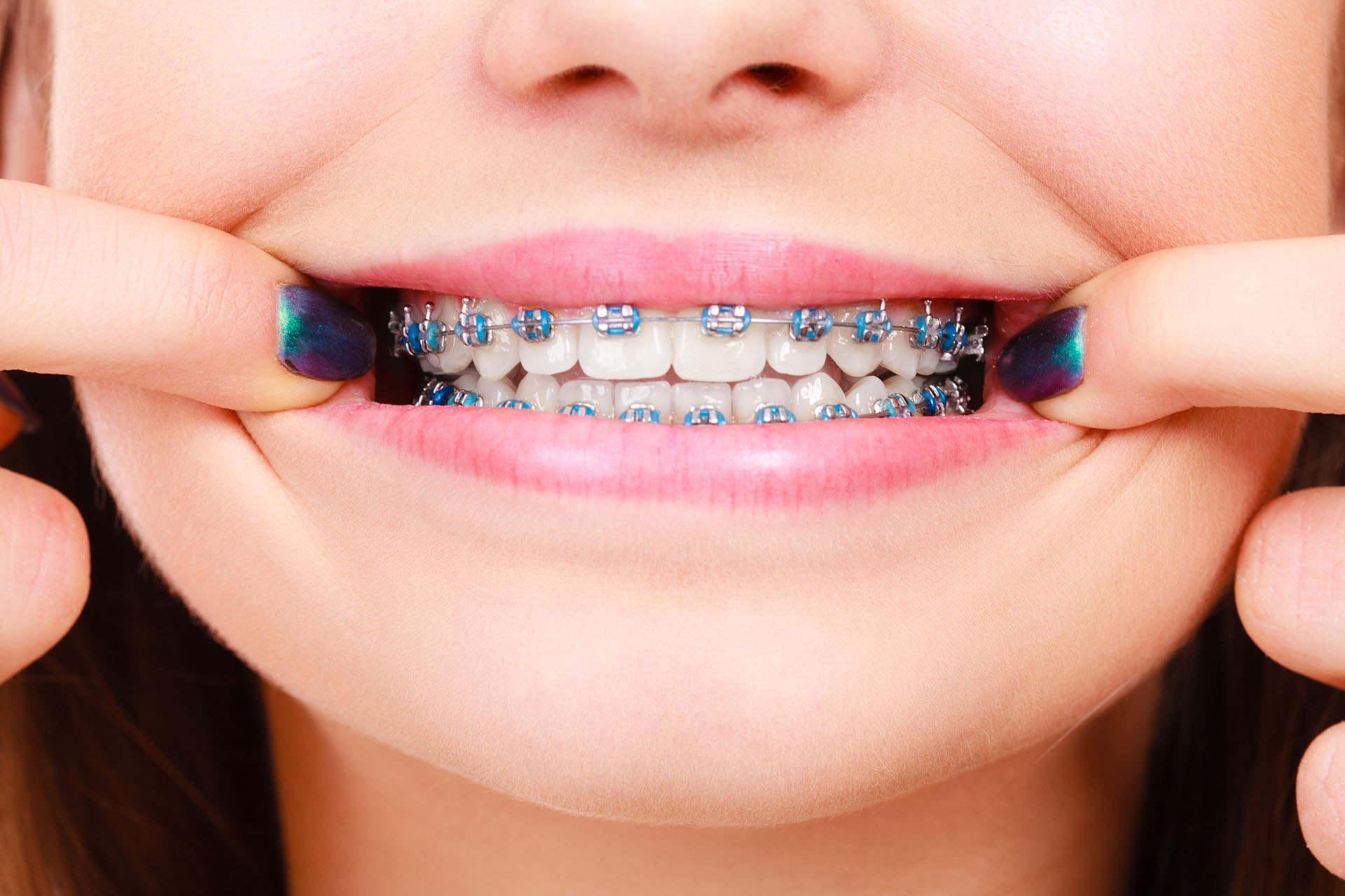 braces 4 - Easy Tips for Cleaning Between Your Teeth When You Have Braces