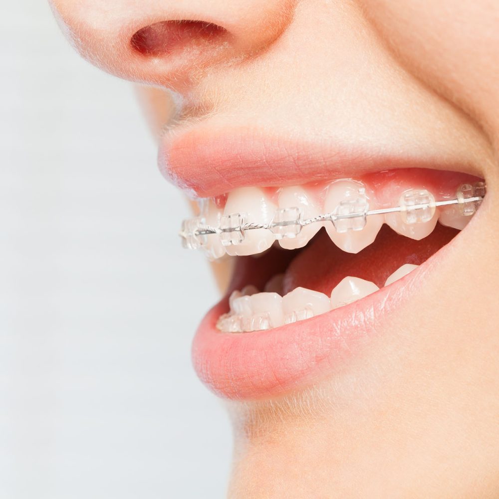 clear braces 1000x1000 - Braces for Kids clear braces 1000x1000 - Braces for Kids