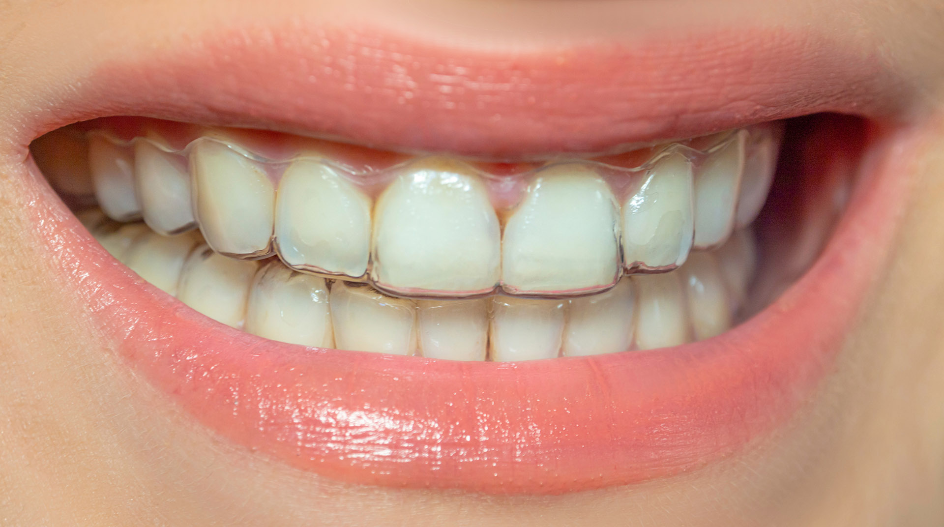 clear aligners 4 - Invisible Aligners in Lindale, TX