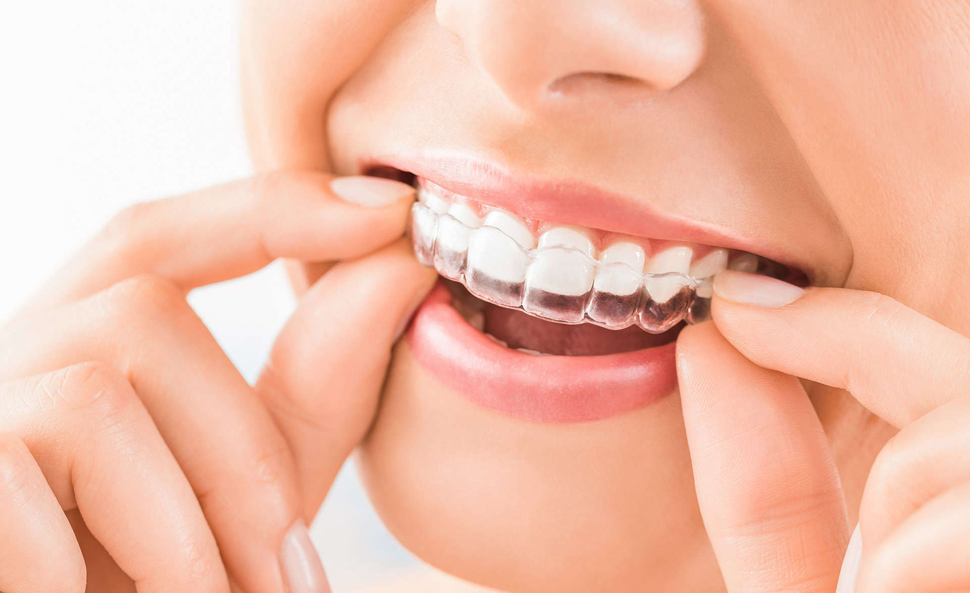 invisalign 2 - The Truth About Clear Aligners: Pros, Cons, and Is It Right for You?